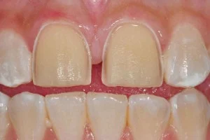 dental veneers: prepared teeth