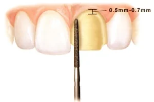 dental veneers: tooth preparation