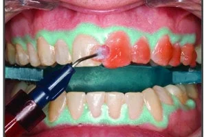 in office teeth whitening procedure step 1
