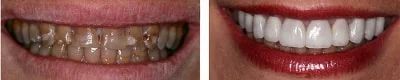 veneers indications: whitening teeth