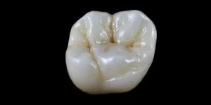 coloratii ceramice de culoare maronie la nivelul unei coroane dentare