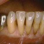 dinti mobili cu retractie gingivala si osoasa ; nu se indica tratamentul prin coroane dentare 