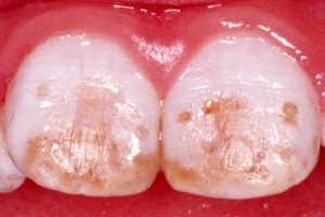 fluoroza dentara