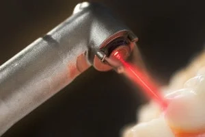 laserul in stomatologie
