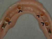 proteza mobilizabila : sisteme de ancorare pentru implanturile dentare