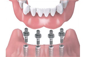 proteza pe implanturi dentare cu sisteme speciale de ancorare