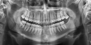 radiografie dentara panoramica