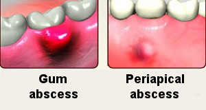 abscess tooth types