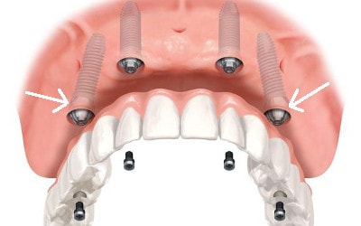 implants abutments angulation