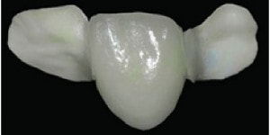 dental composite bridge