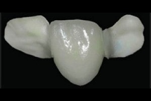 dental composite bridge