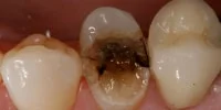 advanced dental decay