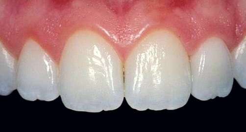 all ceramic crowns upper incisors