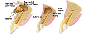 apicoectomy procedure