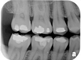 dental X-ray bitewing view