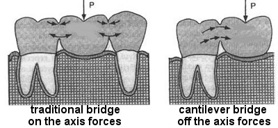 cantilever bridge: acting forces