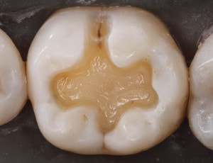 tooth cavity after preparation