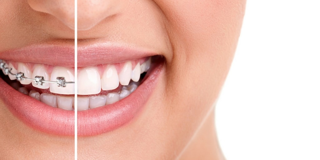 If You Have Misaligned Teeth You Will Need To See an Orthodontist