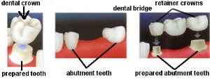 dental crown procedure, dental bridge procedure
