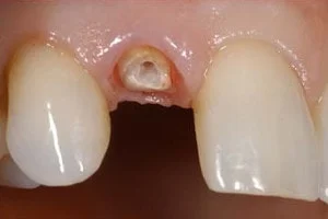 damaged tooth