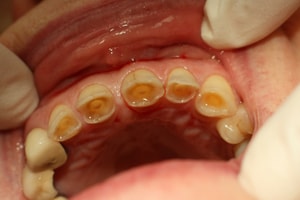 dental abrasion