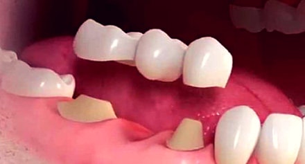 dental bridge with 1 pontic