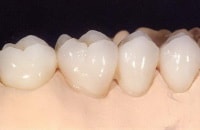dental bridge after dental ceramics build up