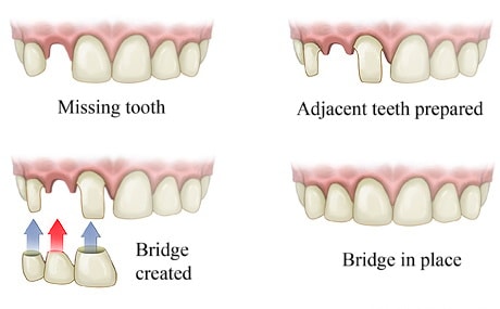 dental bridge design steps