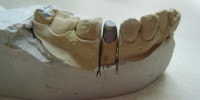 dental cast preparation