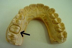 dental cast