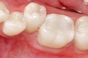 dental composite filling