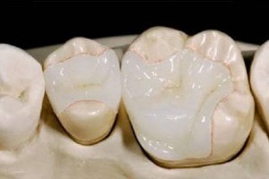 dental composite inlays