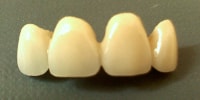 dental composite restoration