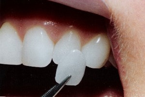 dental composite veneer