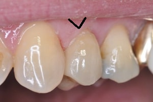 dental crown properly shaped