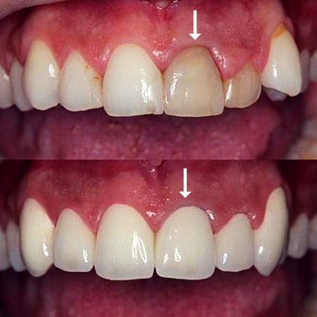 dental crowns can improve aesthetics and the general appearance