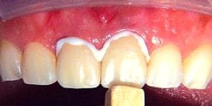 dental crowns cementation