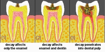 dental decay progression