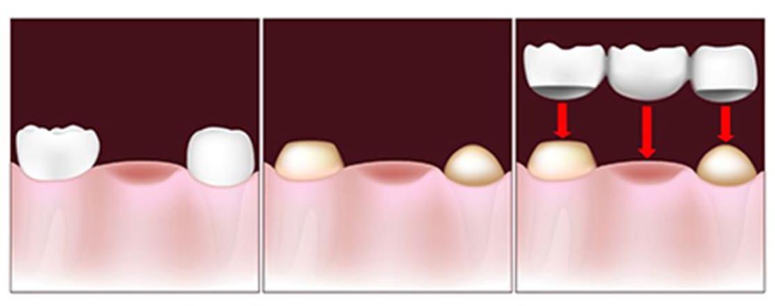 dental implant against dental bridge