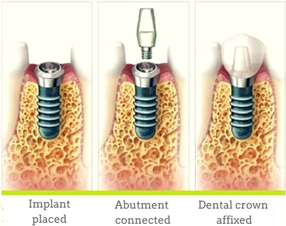 dental implant general procedure