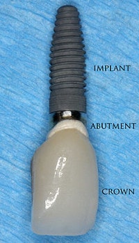 dental implant general structure