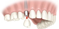 dental implant supported crown