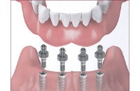 dental implant supported denture