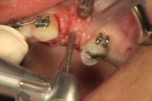 dental implant surgery : drilling