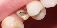 broken tooth; a post and core is indicated
