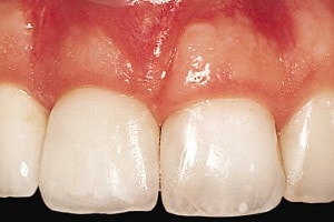 full porcelain crown on the right upper incisor