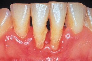 periodontitis : gingival recession