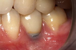 dental implant complications : gingival recession on a an implant