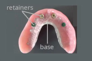implant-supported denture, front view