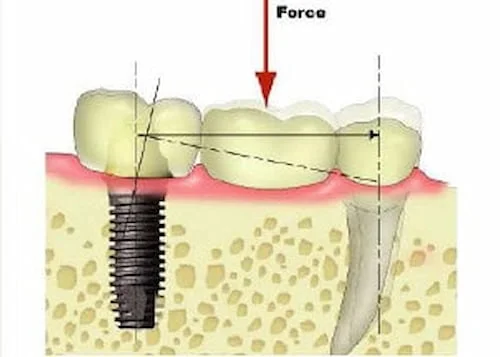 implant-supported bridge, chewing forced